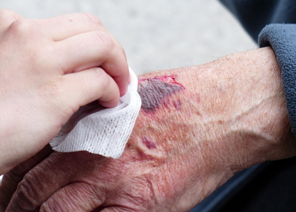 wound care
